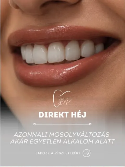 Bp Esztétikai Fogászat Instagram: Direkt héj, mosoly közelről